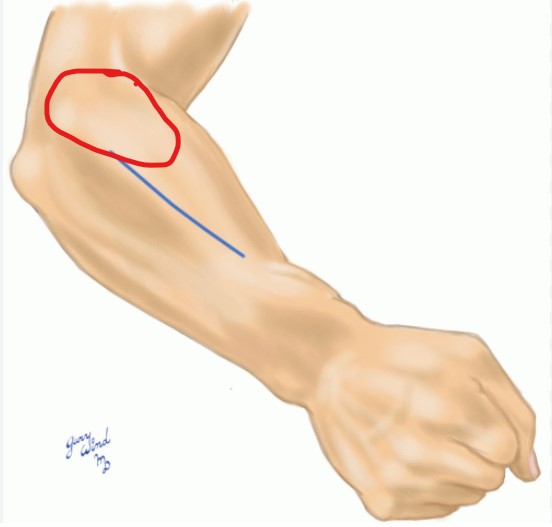 A right arm pictured from the elbow down, slightly bent elbow and hand in fist. The wrist extensor mass is circled in red - it is on the lateral aspect of the elbow.
