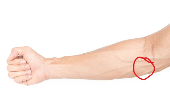A right arm pictured from the elbow down, with thumb up and hand in fist. The wrist flexor mass is circled in red, on the medial aspect (pinky side) of the elbow.