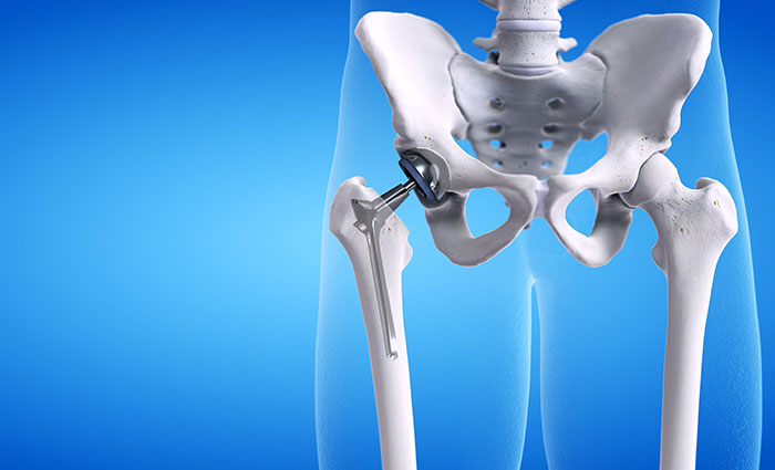Total Hip Replacement: Making the Best Surgical Decision